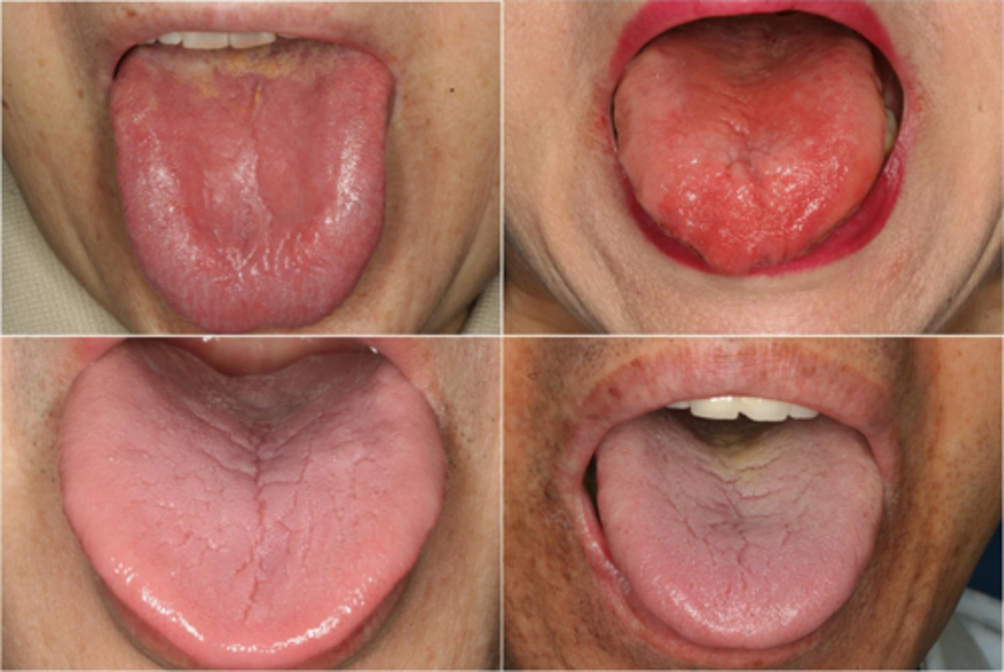 <p>The following are oral manifestations of a deficiency in what vitamin?</p><p>•Glossodynia</p><p>•erythema and depapillation</p><p>of the tongue</p><p>•dry mouth</p><p>•angular cheilitis</p>