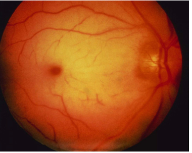 <p><span><em>A 66-year-old woman presents to her primary care physician with a 3-week history of visual spells</em></span></p><p style="text-align: left"><span><em>During each spell she had sudden onset of cloudy darkening of vision in her left eye. Each spell lasted a few minutes and abated suddenly</em></span></p><p style="text-align: left"><span><em>During one spell she covered the left eye and noted normal vision in the right eye</em></span></p><p></p>