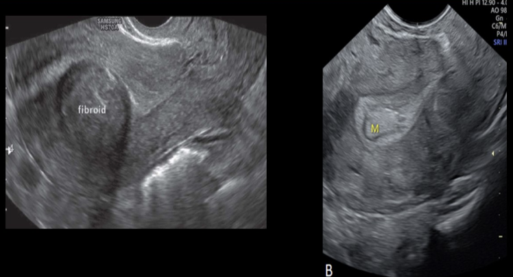 <p>b) fibroids are normally more hypoechoic while polyps tend to be more hyperechoic</p>