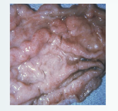 <p>C. parvum infections in snakes cause what disease? Hypertrophic gastritis results with markedly thickened mucosal folds, numerous pinpoint foci of hyperemia, gastric epithelial tropism, anorexia, lethargy, regurgitation, midbody swelling and weight loss, poor prognosis, and culling of the animal.</p>