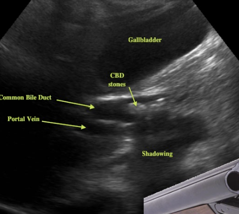 <p><span>dilated common bile duct</span></p><p><span>Portal Vein and Bile Duct near the same size due to dilation of the Bile Duct</span></p><p><span>See parallel tubular structures in the portal triad with two tubes about the same size.</span></p>