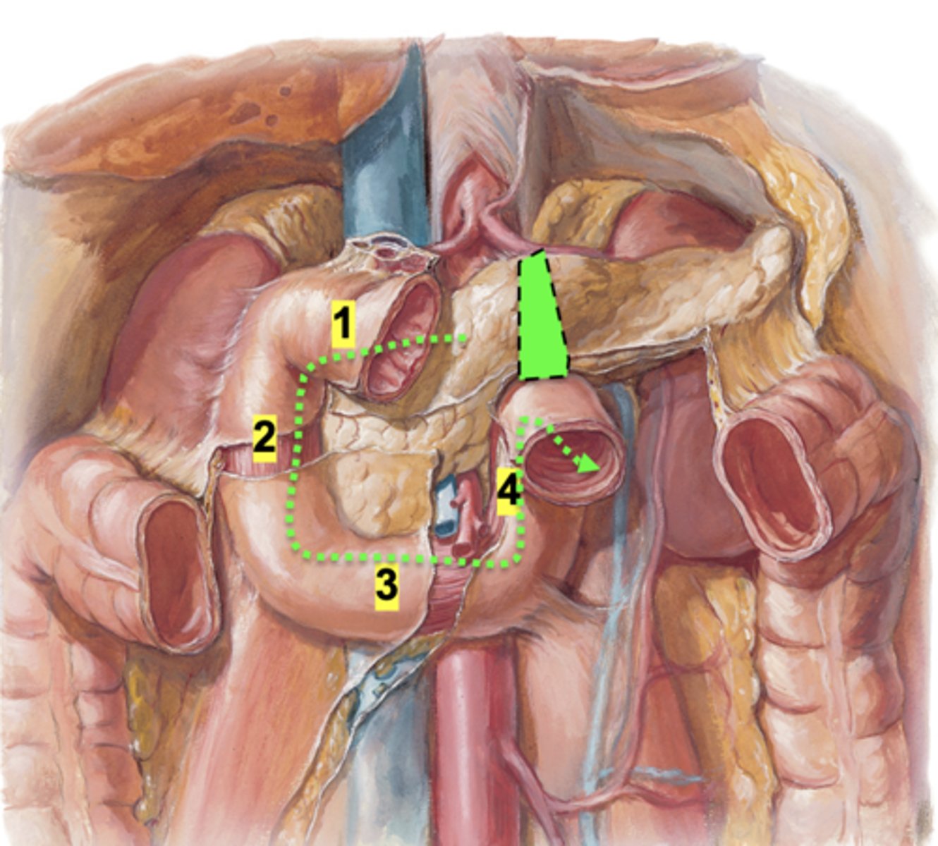 <p>Injury before the ligament - GI blood appear dark, tarry stool (melena)</p><p>Injury after the ligament - GI blood appear bright red</p>