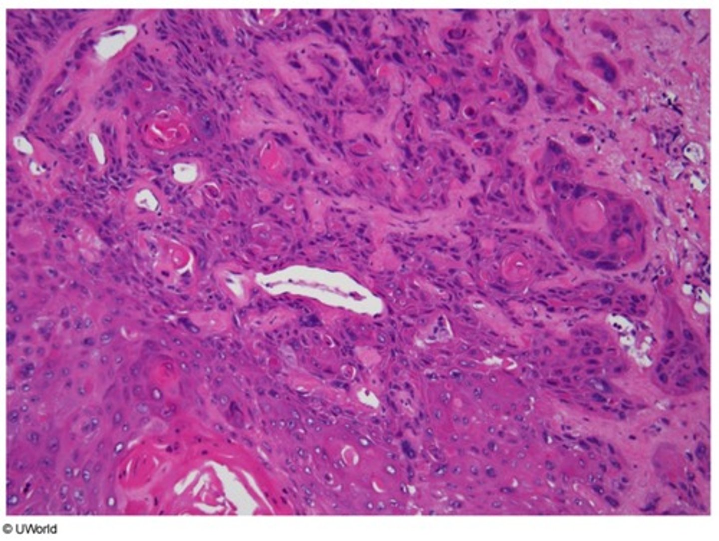 <p>Risk Factors</p><p>-HPV (If the lesion appears in the Throat)</p><p>-EBV (If lesion appears in the Nose)</p>