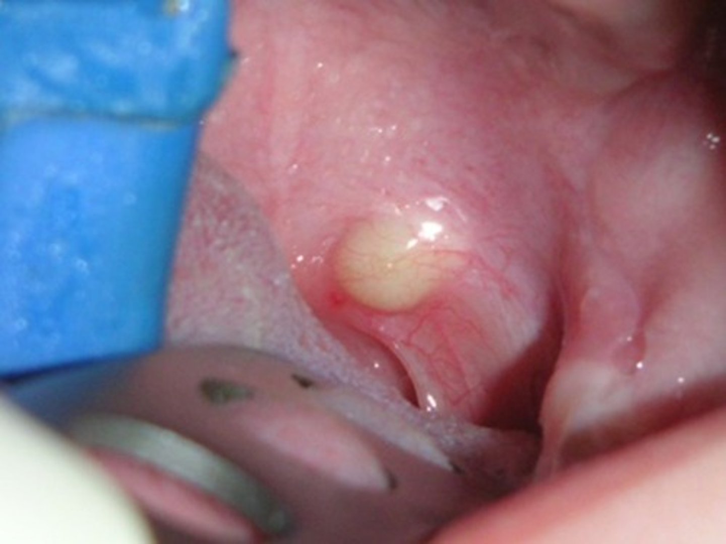 <p>well-defined pinkish-yellow raised nodule</p>