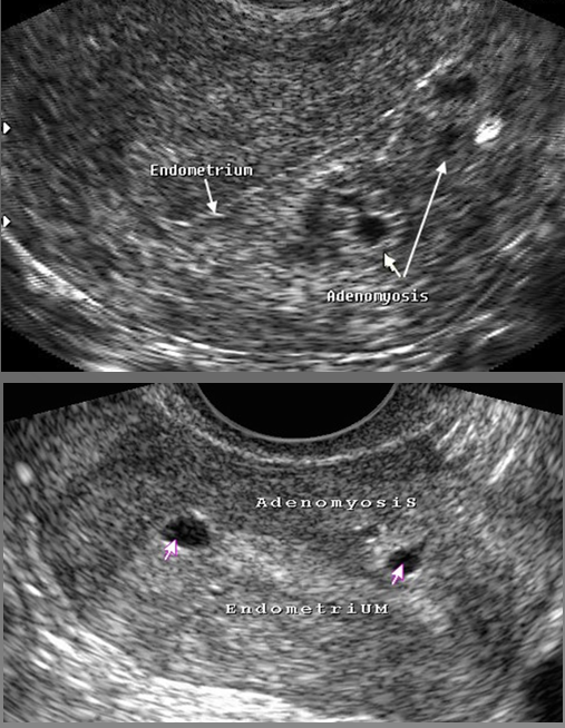 <p>Focal adenomyosis appears as isolated _______</p>