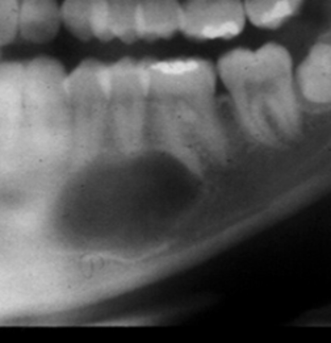 <p>How do you know that this is NOT a Stafne defect?</p>