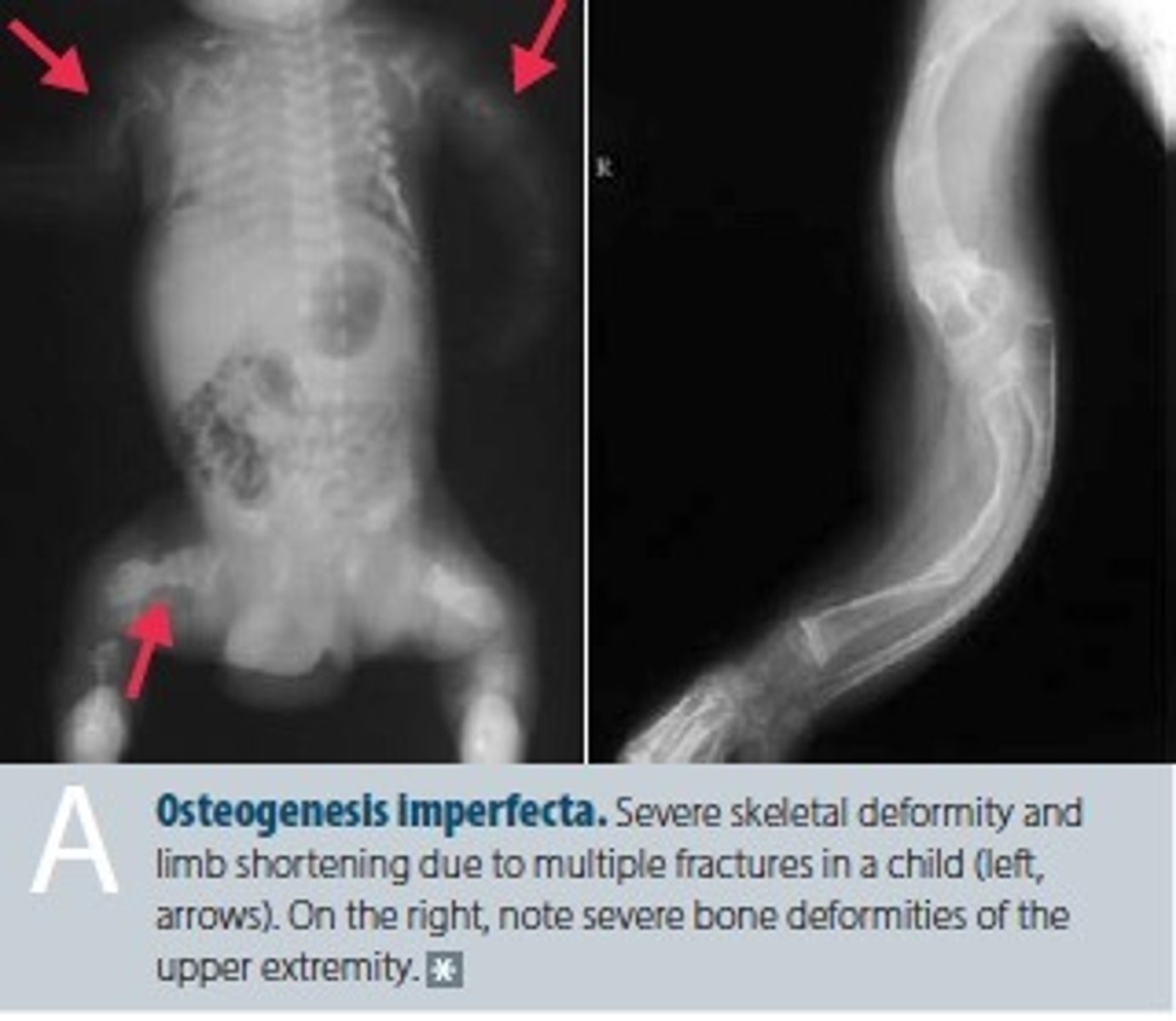 <p>Deformities:</p><p>- Tibia</p><p>- Carpal bone </p><p>Fractures and callouses:</p><p>- Femurs </p><p>Forearms bones are typically shortened, thinned and bowed as well </p>