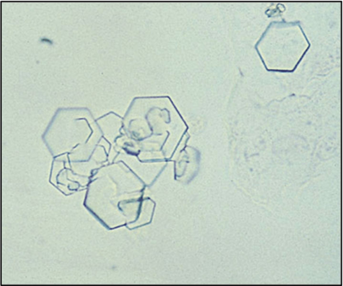 <p>-Abnormal= due to metabolic disorder that prevents reabsorption of cystine by the renal tubules.</p><p>-Confirmatory test= cyanide-nitroprusside test</p><p>-pH= Acid</p><p>-Color/Form= Colorless (hexagonal plates)</p><p>-disorders= inherited cystinuria</p>