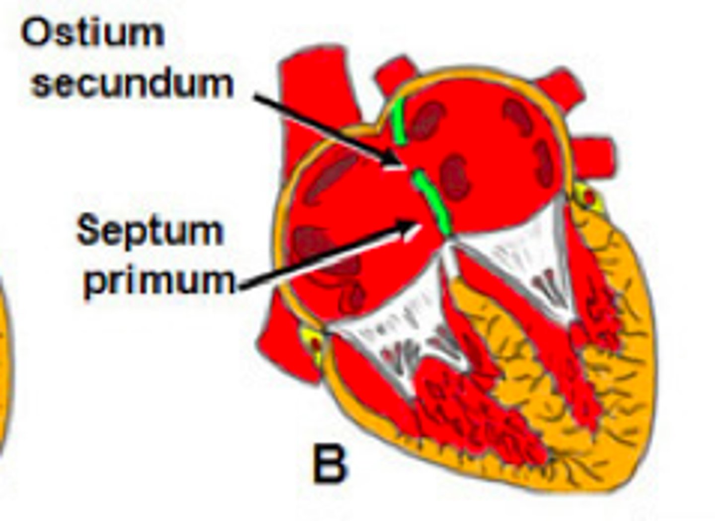 <p>- a defect in the middle portion of the atrial septal defect</p><p>- most common type of ASD</p>