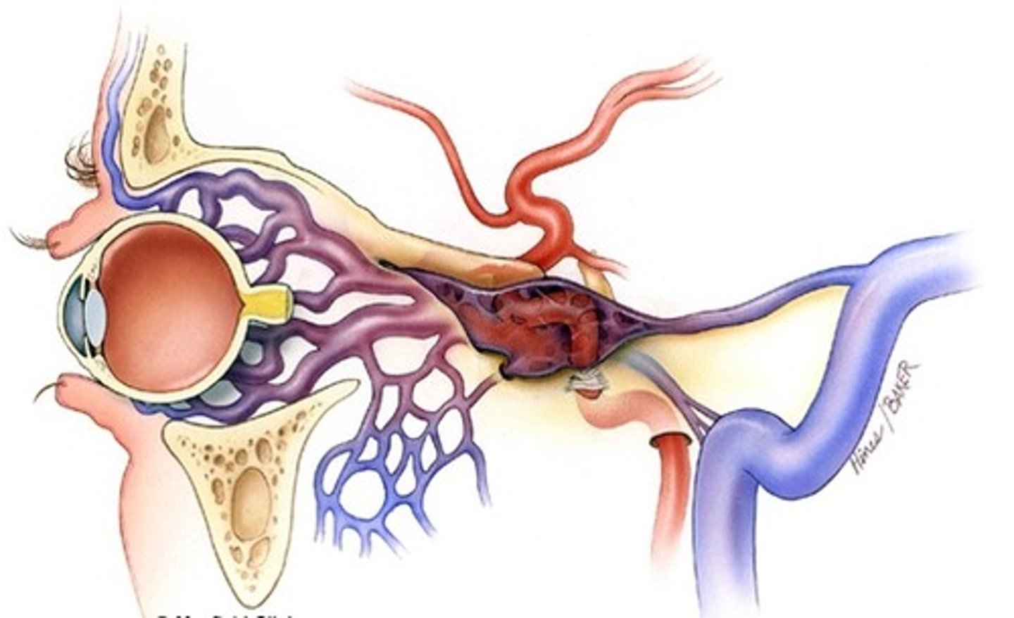 <p><strong>abnormal communication</strong> between the <strong>ICA </strong>and<strong> Cavernous Sinus.</strong></p><p></p><p>caused by a tear in the artery wall.</p><p></p><p>veins may become <strong>pulsatile</strong>.</p><p></p><p><span class="bgP">can </span><strong><span class="bgP">increase aqueous outflow resistance</span></strong><span class="bgP">, leading to </span><strong><span class="bgP">high IOP.</span></strong></p>