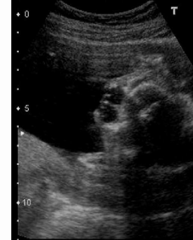<p>this is ___ which is a common finding in</p><p>a) cystic hygroma, monosomy x</p><p>b) hypertelorism, trisomy 21</p><p>c) cerebellar agenesis, dandy walker syndrome</p><p>d) hypotelorism, trisomy 13</p>
