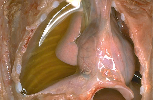 <ol><li><p>Describe kind of effusion?</p></li><li><p>Location of the effusion?</p></li></ol>