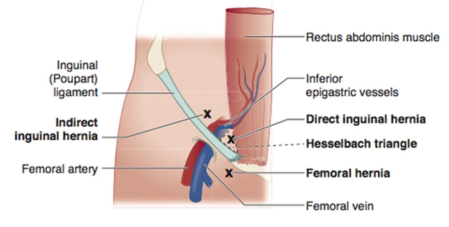 <p>Indirect inguinal</p>