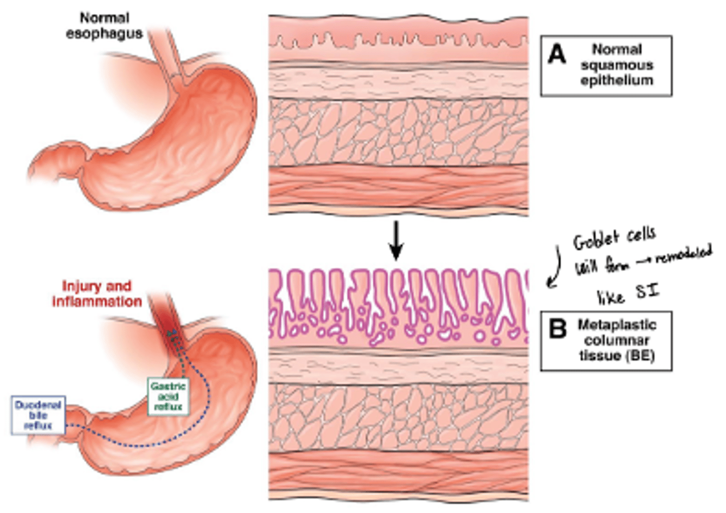 <p>o Repeated injury and inflammation will break down the normal squamous epithelial layer of the esophagus</p><p>o Will grow back as columnar epithelium--> intestinal metaplasia (with goblet cells)</p>