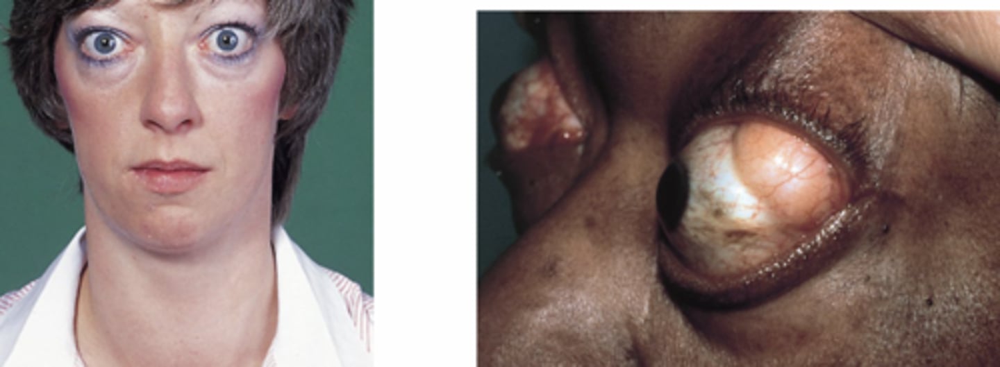 <p>occular involvement - unique to graves disease:</p><p>-characteristic stare w/ eyelid retraction and lid lag</p><p>-exophthalmos (protrusion) due to accumulation of glycoasminoglycans in retro-orbital CT</p>