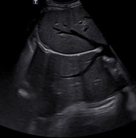 <ul><li><p><span style="background-color: transparent;">Occurs when the beam encounters a large specular reflector</span></p></li><li><p><span style="background-color: transparent;">Appears as duplication of objects opposite of a highly reflective structure</span></p></li><li><p><span style="background-color: transparent;">May be reduced by changing approach</span></p></li><li><p><span style="background-color: transparent;">Common behind the diaphragm</span></p></li></ul><p></p>