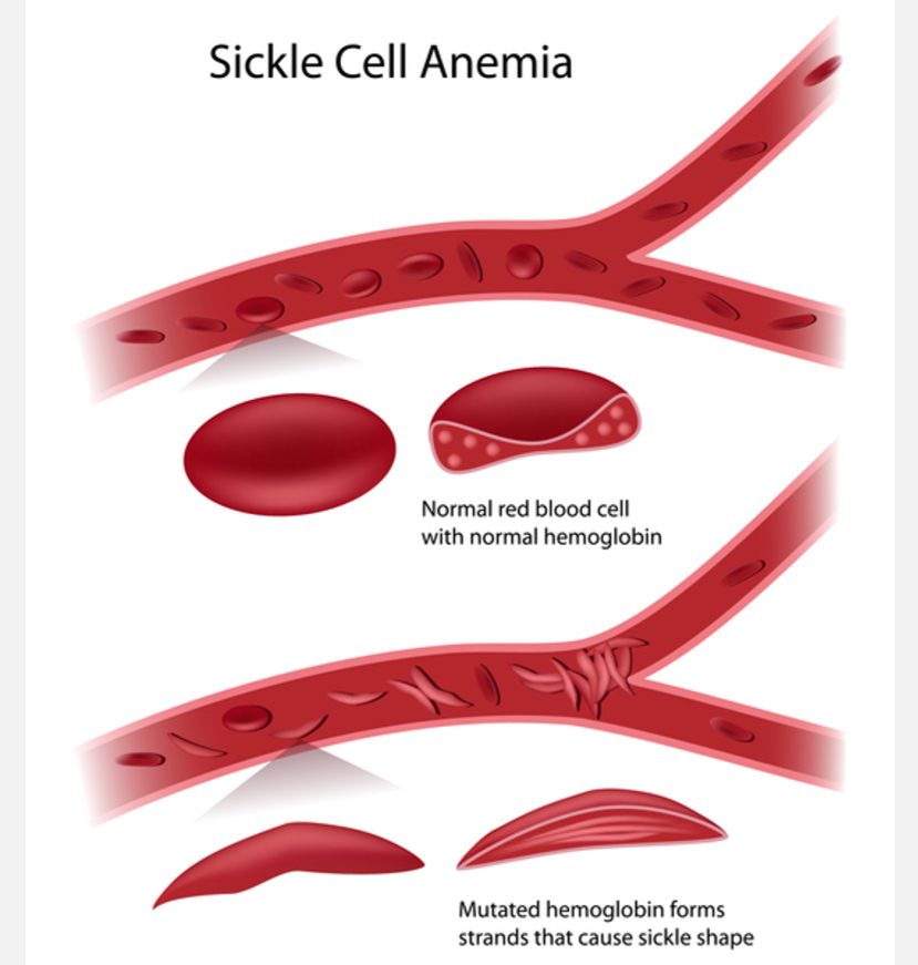 <p><span style="font-family: UICTFontTextStyleBody; font-size: 17px;">SNV in HBB gene: Glu6Val mutation.</span></p><p class="p1"></p><p class="p1"><span style="font-family: UICTFontTextStyleBody; font-size: 17px;">Homozygous (HbSS) → SCD.</span></p><p class="p1"><span style="font-family: UICTFontTextStyleBody; font-size: 17px;">Heterozygous (HbAS) → carrier, usually healthy, resistant to severe malaria.</span></p><p class="p1"></p><p class="p1"><span style="font-family: UICTFontTextStyleBody; font-size: 17px;">Mutation ~7300 years ago.</span></p><p class="p1"></p><p class="p1"><span style="font-family: UICTFontTextStyleBody; font-size: 17px;">Common in malaria-endemic regions (Africa, Middle East, Mediterranean, India).</span></p>