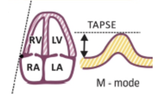 <p>Using <strong>M-Mode</strong> at <strong>AP4</strong>, Place cursor through TV annulus and measure the <u>longitudinal</u> motion of TV anulus at peak systole</p>