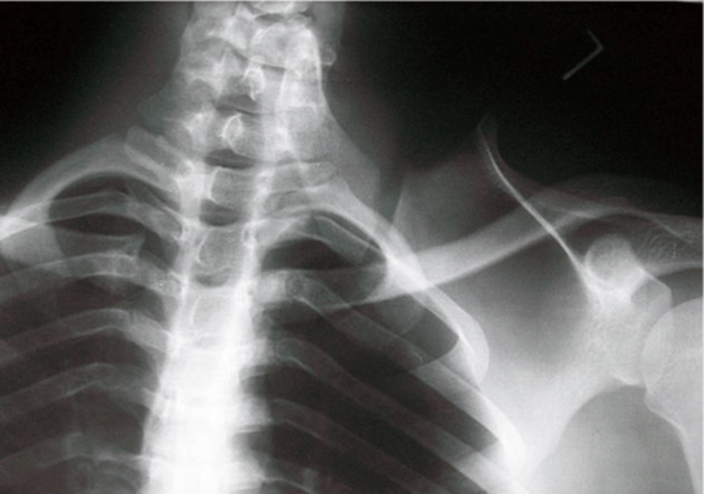 <p>May be fibrocartilaginous (can't see on x-ray)</p>