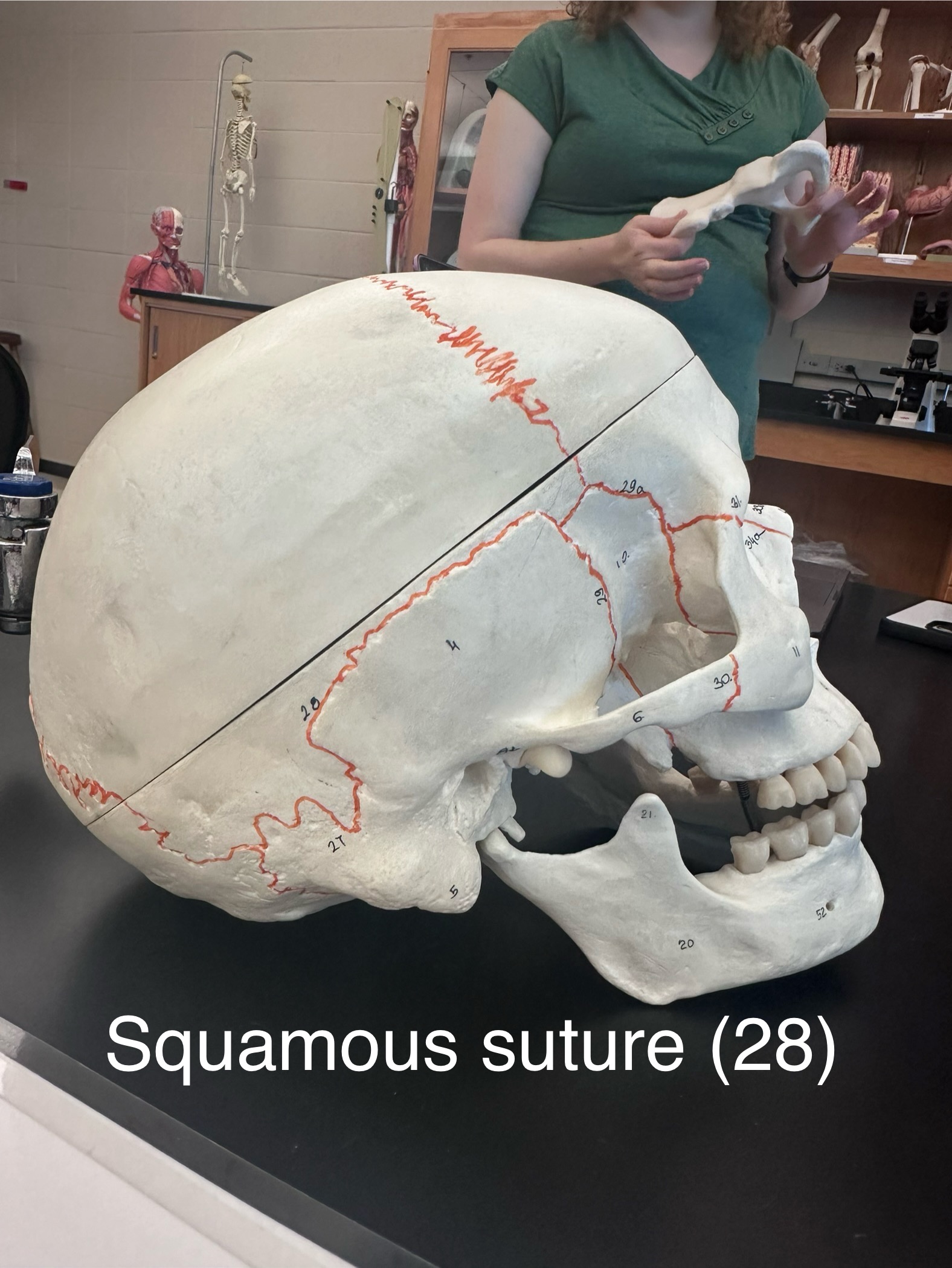 <p>Squamous Suture</p>