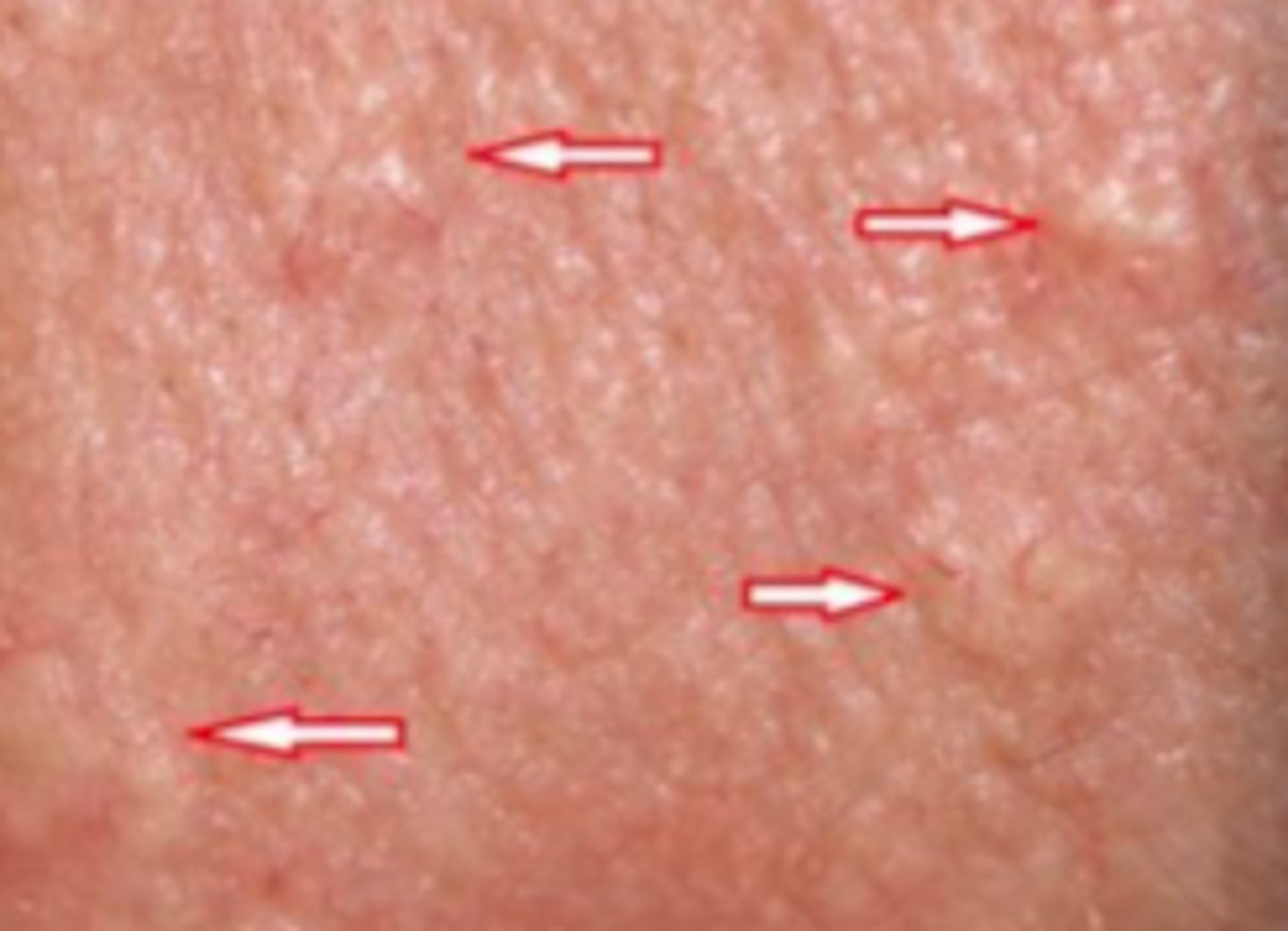 <p>Acneiform Disorders:</p><p>Overview:</p><p>- Common, benign condition of sebaceous glands</p><p>- Occurs in adults (middle-aged males)</p><p>- Can be bothersome but rarely require treatment</p><p>- Main concern: clinical dresemblance with other neoplastic lesions</p><p>- Decreasing levels of androgens lead to decrease in sebocyte turnover, which activates feedback of stimulation of sebocyte proliferation within the glands and sebaceous hyperplasia</p>