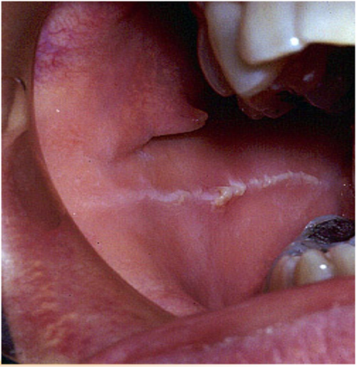 <p>-white line that extends anteroposteriorly on buccal mucosa along the occlusal plane</p><p>-may be bilateral</p><p>-may be prominent in pts who clench or bruxism habit</p>