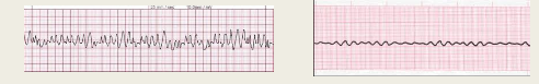 OMG rhythm! \n Immediate intervention needed – no pulse being generated – begin CPR

Patient will NOT be conscious

Ventricles are quivering – no wave forms on EKG \n Needs defibrillation (AED)