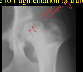 <ul><li><p><strong>Cause</strong></p><ul><li><p>Young <strong>SMALL</strong> dogs</p></li><li><p><strong>necrosis</strong> of the capital <strong>femoral epiphysis </strong>from<strong> poor blood supply</strong></p></li><li><p><strong>Unilateral</strong></p></li></ul></li><li><p><strong>CS</strong></p><ul><li><p><strong>Weight bearing lamenes</strong>s, leg pain</p></li></ul></li><li><p><strong>RS</strong></p><ul><li><p>Increased width of joint space and opacity of femoral head, patchy lysis</p></li></ul></li><li><p>FHO sx</p></li></ul><p></p>