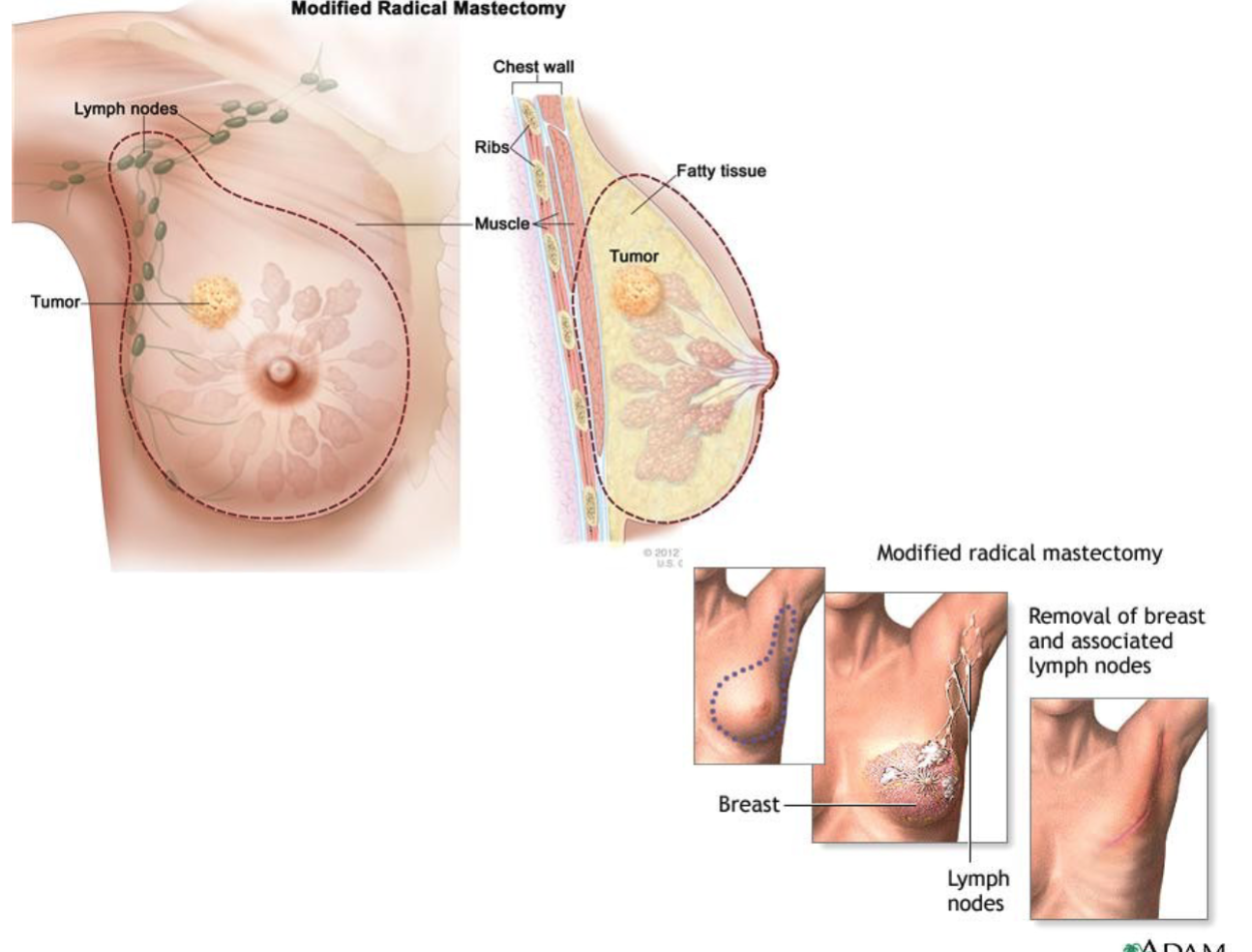 <p>Removal of:</p><ul><li><p>The entire breast</p></li><li><p>Axillary lymph nodes<br>But chest muscles are left in place.</p></li></ul><p></p>