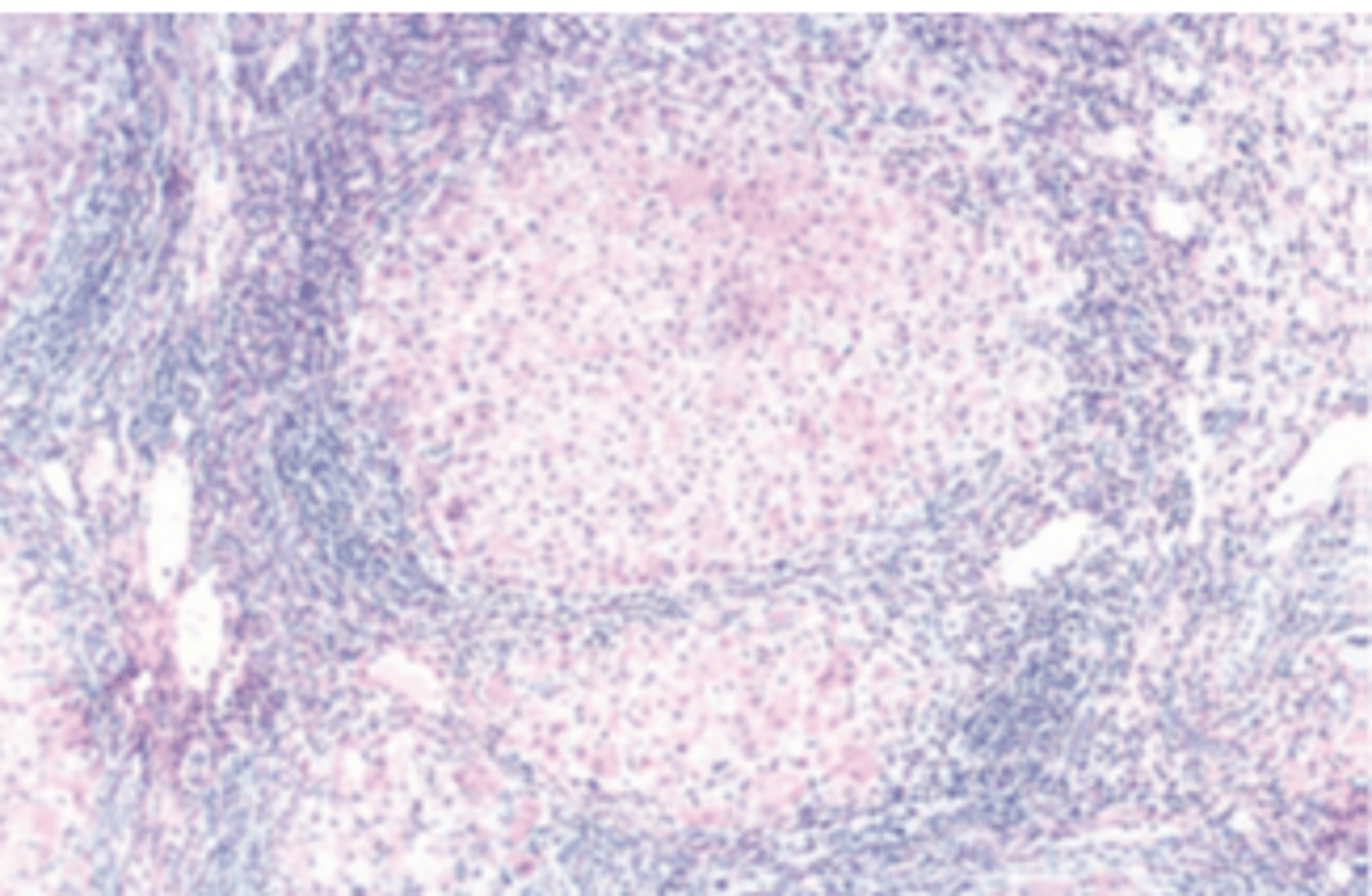 <p>A 30-year-old man presents with a 9-month history of fatigue and recurrent fever. He also complains of yellow skin and sclerae, abdominal tenderness, and dark urine. Physical examination reveals jaundice and mild hepatomegaly. Laboratory studies demonstrate elevated serum bilirubin (3.1 mg/ dL), decreased serum albumin (2.5 g/dL), and prolonged prothrombin time (17 seconds). Serologic tests reveal antibodies to hepatitis B core antigen (IgG anti-HBcAg). The serum is positive for HBsAg and HbeAg. A liver biopsy is shown in the image. What is the most likely diagnosis?</p><p>(A) Acute hepatitis B</p><p>(B) Alcoholic hepatitis</p><p>(C) Chronic hepatitis B</p><p>(D) Delta virus infection</p><p>(E) Subacute hepatic necrosis secondary to hepatitis B infection</p>