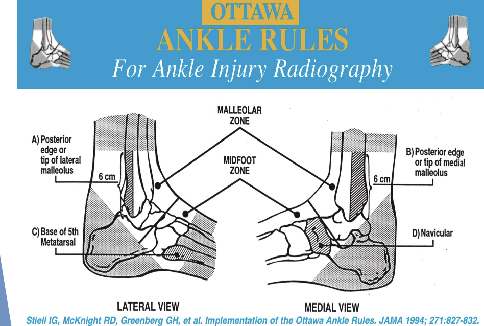 <p>Ottawa Ankle Rules</p>