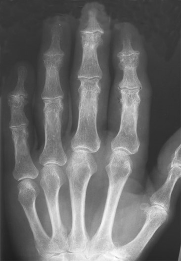 <p>Osteoarthritis or degenerative joint disease</p>
