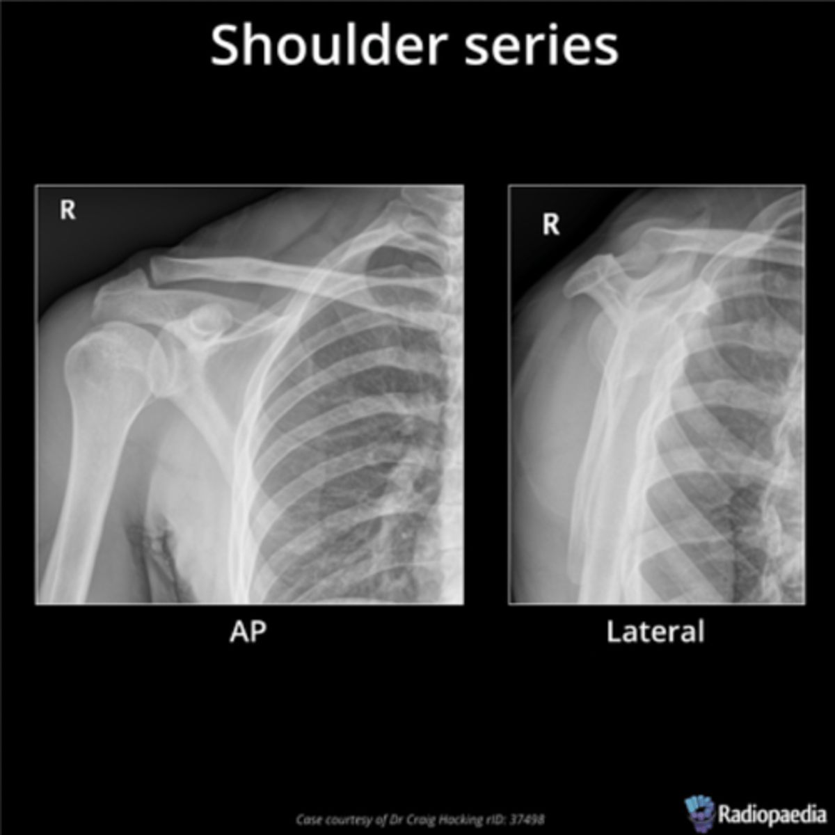 <p>When is a shoulder x-ray indicated?</p>