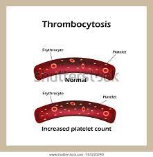 <p>a condition characterized by an elevated level of platelets in the blood</p>
