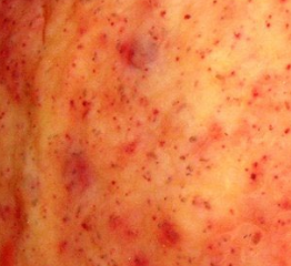 <p>-most horses symptomatic</p><p>-may cause weight loss, anemia, low protein</p><p>larvae encyst in walls of large intestine- clinical signs arise when the strongyles emerge (spring)--> severe diarrhea</p>