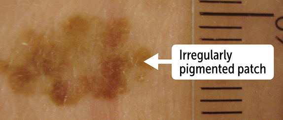 <p>Report the <strong>width and the height of the lesion, </strong>which is measured in <strong>mm or cm</strong></p><ul><li><p>“<span>there is a 7 mm by 14 mm </span><u>patch</u><span>”</span></p></li></ul><p>Usually, a pigmented lesion larger than 6mm in size will <strong>raise suspicion for malignancy</strong></p><p></p>