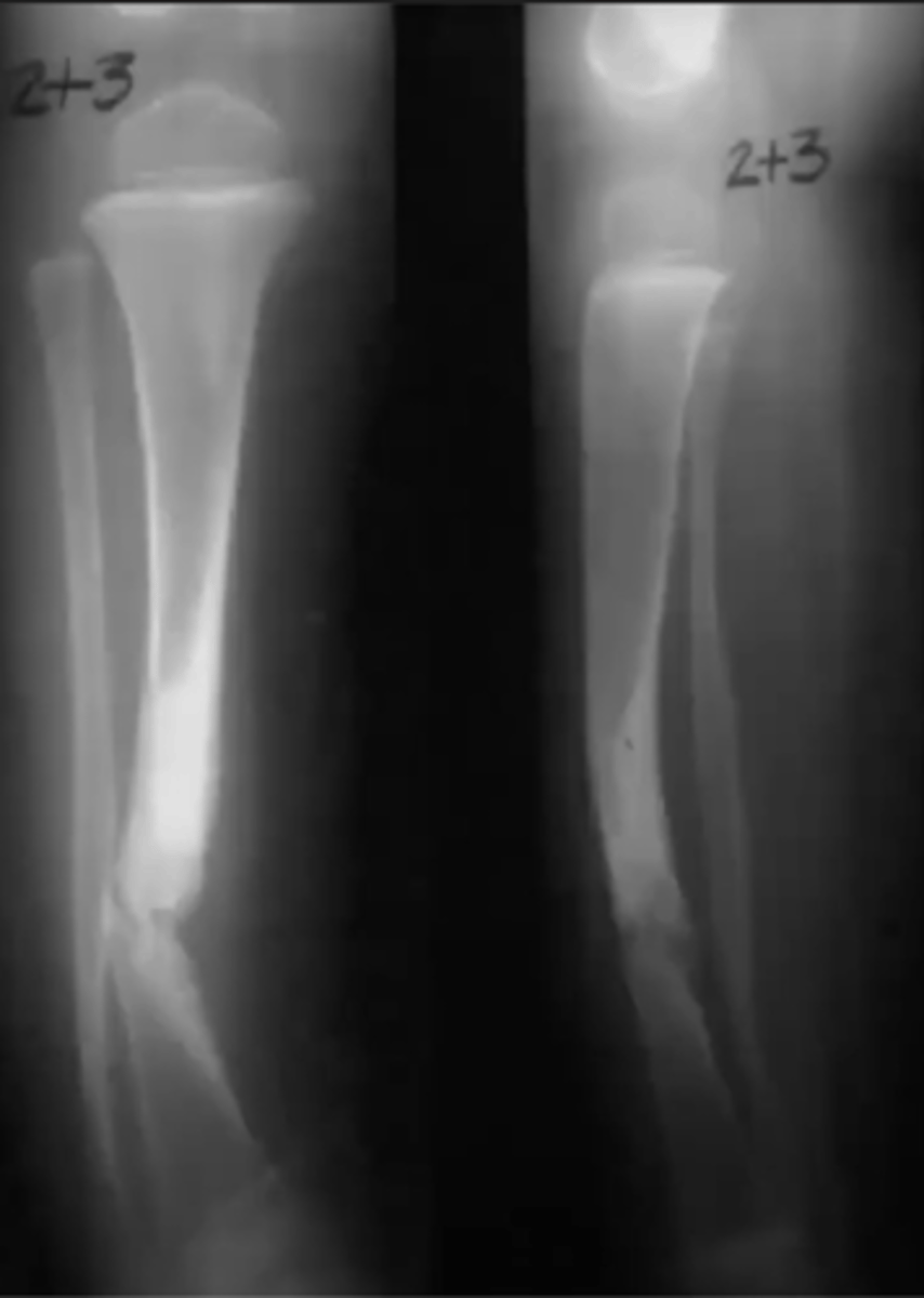 <p>What is this?</p><p>Ex. Pt has Fibroma Molluscum, Cafe Au Lait spots + Coast of California, Kyphoscoliosis</p>