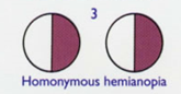 <p>homonymous hemianopia</p>