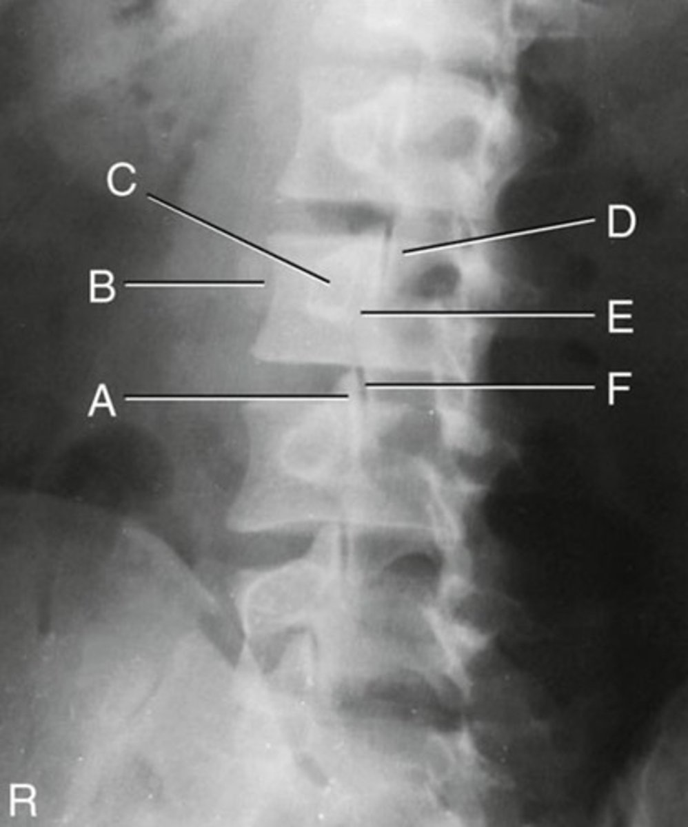 <p>Label F (btwn L4-L5)</p>