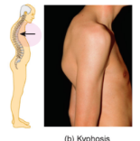 <ul><li><p>hunchback</p></li><li><p>caused by an exaggerated thoracic curve which can be caused by osteoporosis</p></li></ul><p></p>