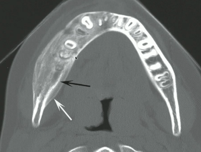<p>what is indicated by the white arrow</p>