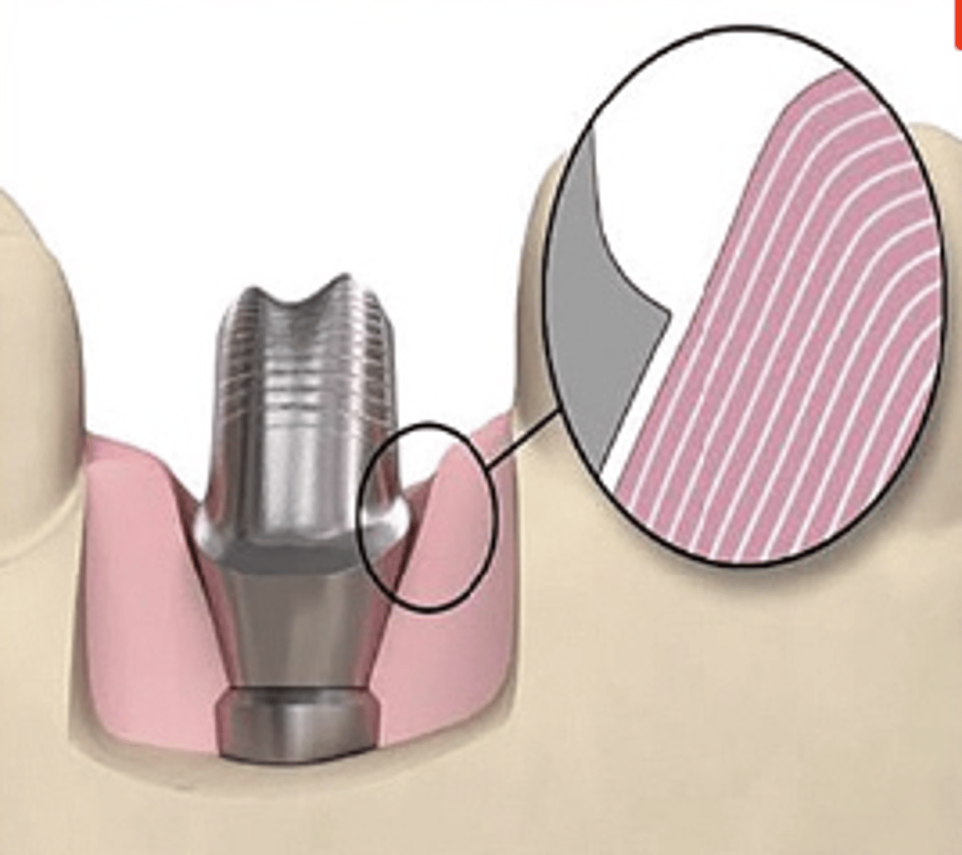 <p>What type of abutment?</p><p>- Smallest-diameter, non-anatomically shaped abutment with no soft tissue support</p><p>- Abutment will not touch the soft tissue</p>