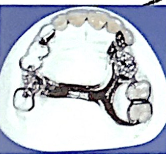 <ul><li><p>Description : dégage la partie du palais, épaisseur importante</p></li><li><p>indication : classes III</p></li><li><p>contre-Indication : palais étroit et profond </p></li></ul><p></p>