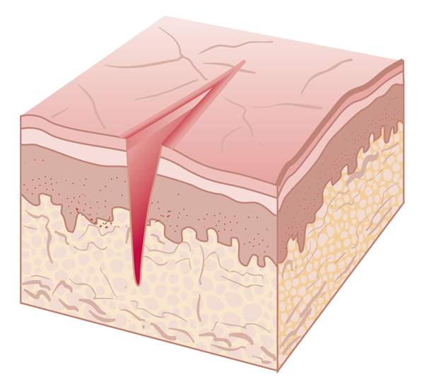 <p>linear, wedge-shaped crack extending into the dermis</p>