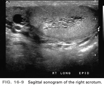 <p>A 76-year-old patient presents with a history of palpable mass in superior portion of the right scrotal sac. A nonvascular cystic mass is identified in the medial portion of the testis. This is suspicious for</p>