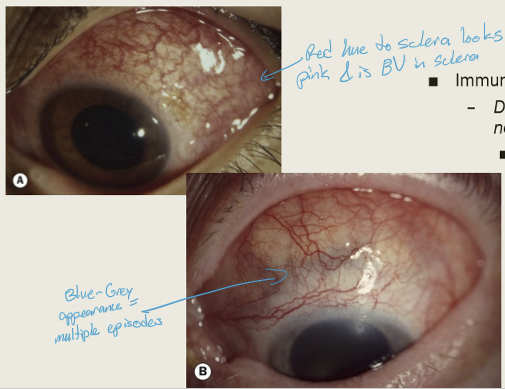 <p>Severe aching pain that radiates to the face and temple region.</p>