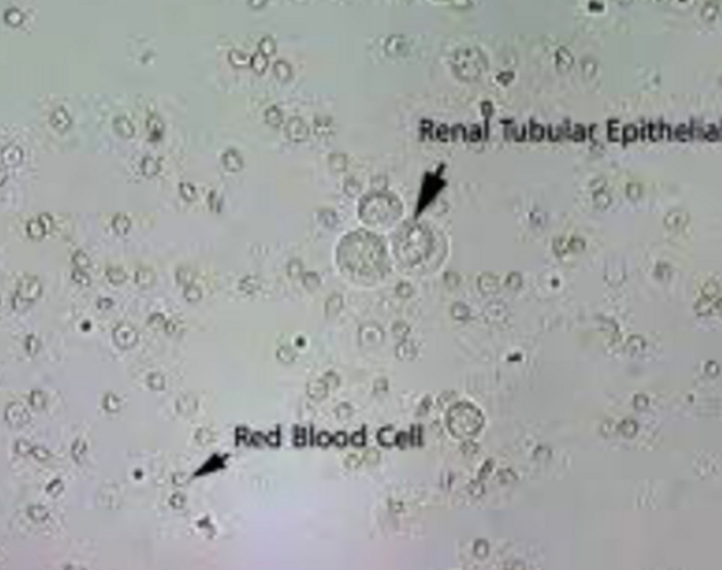 <p>- Normal to see 0-1 in each field</p><p>- Increased number indicates cystitis, pyelonephritis, or renal tubule disease</p><p>- Come from kidneys</p><p>- Smaller than other cells but slightly larger than WBCs</p><p>- Large, round nucleus</p>