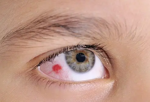 <p>PP: outside blood vessels leak blood→homogenous+sharply demarcated red area</p><p>E: none<br>or<br>trauma<br>bleeding dx<br>cough→sudden increase in venous pressure</p><p>CM: no pain<br>vision not affected<br>no discharge<br>pupil not affected<br>clear cornea</p><p>P: resolves over 2 weeks</p>