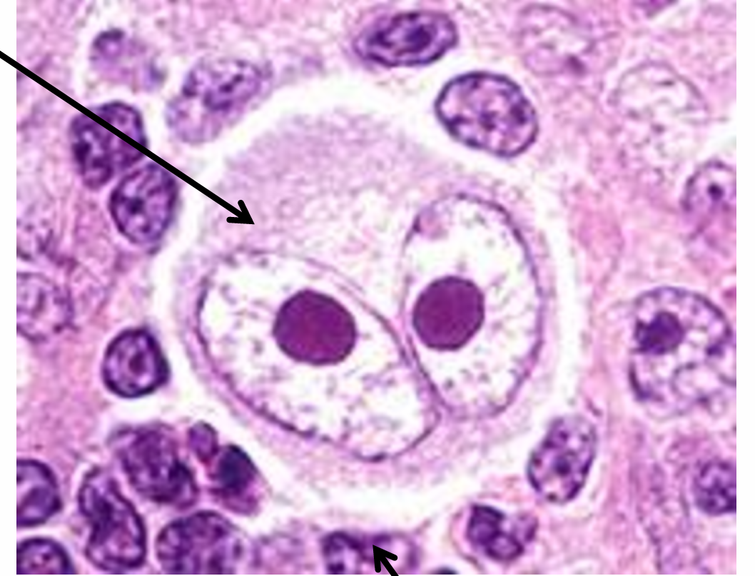 <ol><li><p>Large cells </p></li><li><p>Abundant pale cytoplasm</p></li><li><p>Binucleate with prominent nucleoli (Reed-Sternberg cells)</p></li><li><p>Surrounding reactive inflammatory cells (Most cells of the tumor)</p></li></ol><p></p>