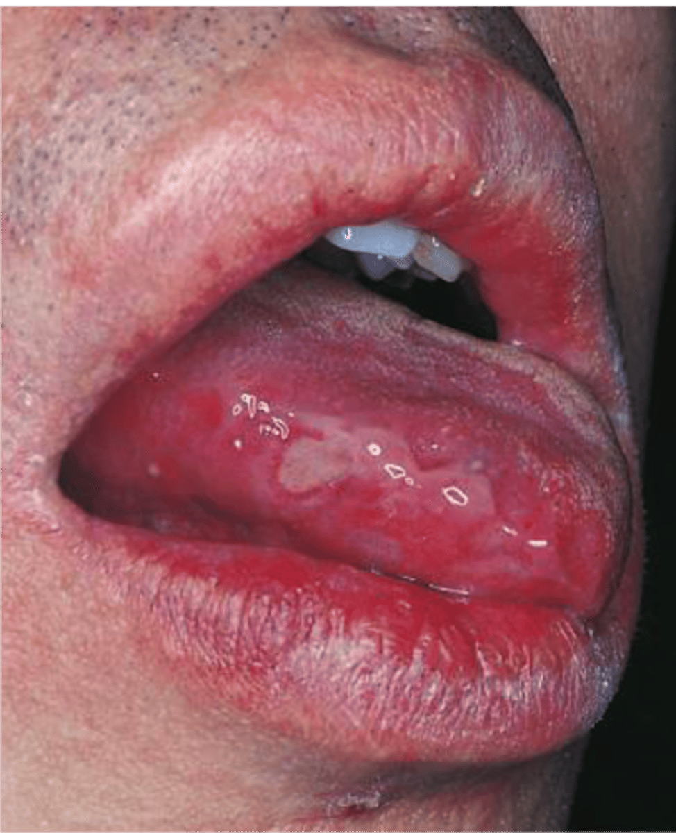 <p>Behçet syndrome</p>